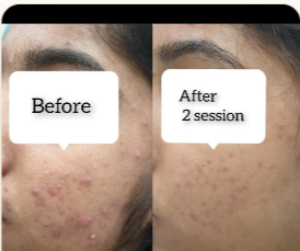 Acne · 2 Sessions