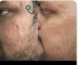 Acne Scar · MNRF + GFC