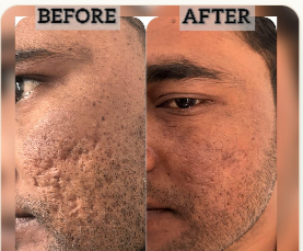 Acne Scar Revision