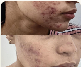 Acne Treatment · Progress