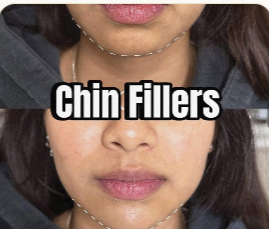 Chin Fillers · Jawline