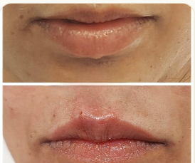 Lip Fillers · Volume