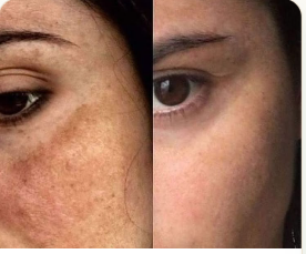 Pigmentation · Cheeks