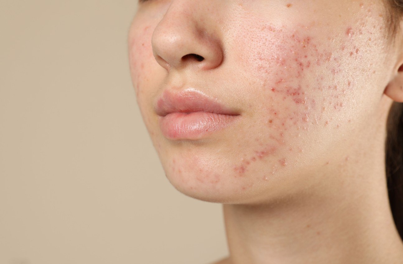 Acne, scars and active breakouts treatment visual