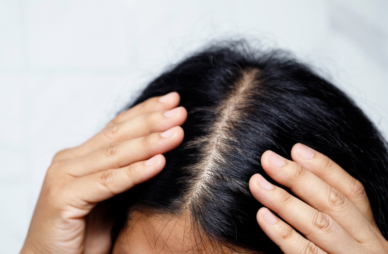 Hair fall scalp and GFC visual
